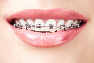 Orthodontic Hygiene Soltuions